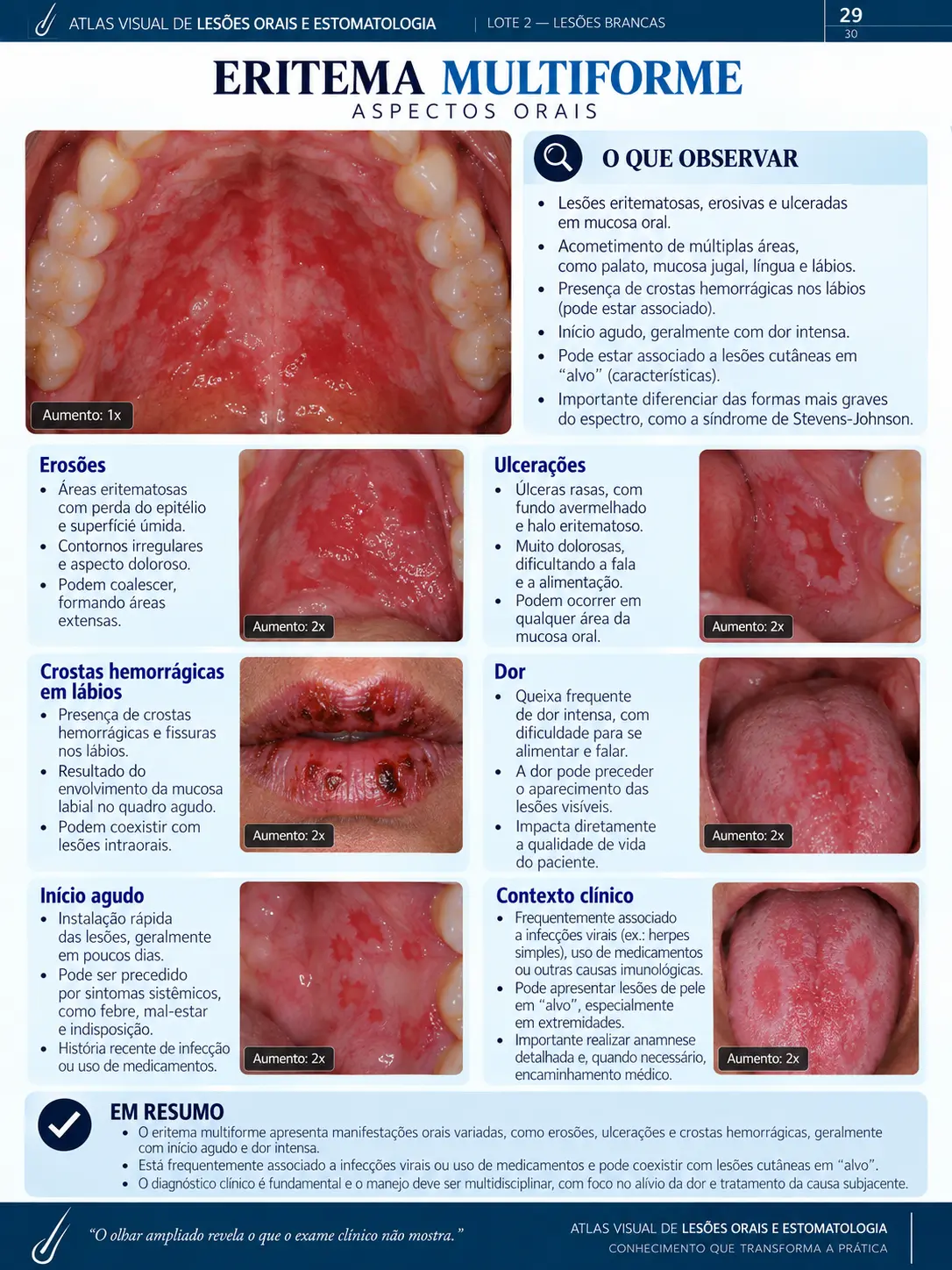Página do ORALMAP: Carcinoma Espinocelular